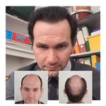 Capital Hair Restoration - Hair Transplant - photo 3