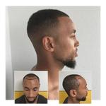 Capital Hair Restoration - Hair Transplant - photo 6