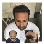 Capital Hair Restoration - Hair Transplant - photo 7