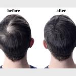 Srinagar Hair Transplant - photo 1