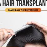 Srinagar Hair Transplant - photo 2