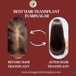 Srinagar Hair Transplant - photo 1