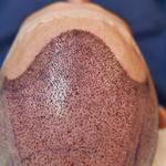 Srinagar Hair Transplant - photo 2