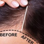 Srinagar Hair Transplant - photo 3