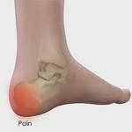 spurpodiatry - photo 4