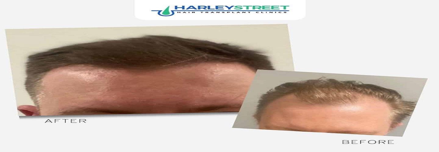 Harley Street Hair Transplant Clinic Liverpool cover photo